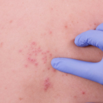 Why you might have a shingles flare-up after your COVID vaccination