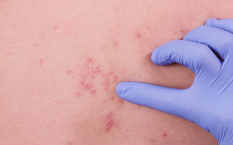 Why you might have a shingles flare-up after your COVID vaccination